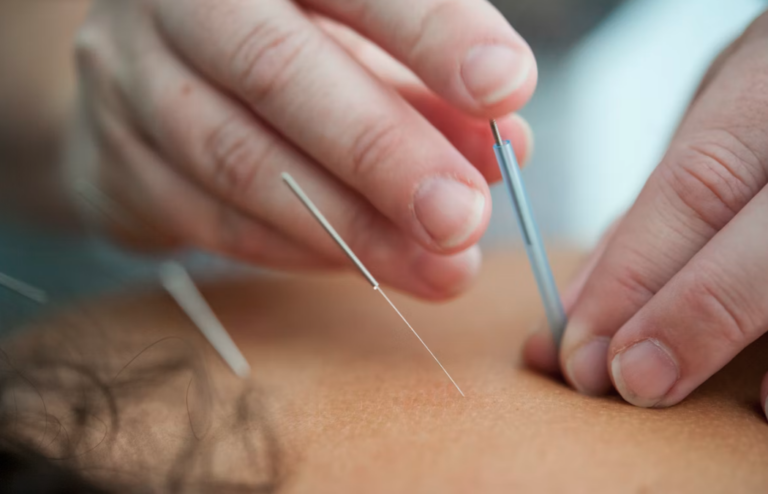Acupuncture's Benefits for Reproductive Health