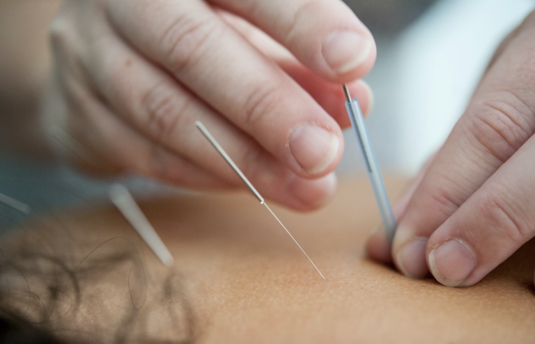 PCOS Should Consider Acupuncture