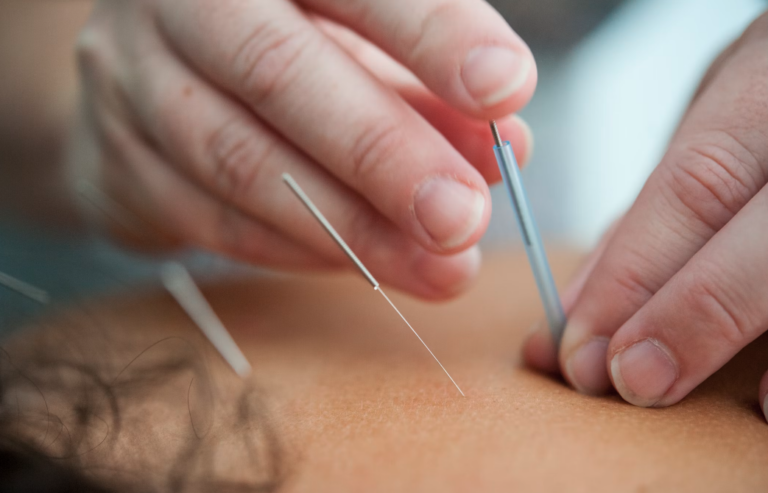 12 Acupuncture Points That Target Endometriosis Pain and Discomfort